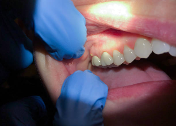 Best Broken or Cracked Tooth Emergency Dentist in Algona, IA